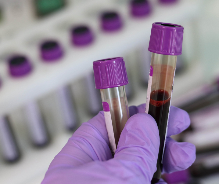Neuer Bluttest identifiziert über 20 Krebsarten