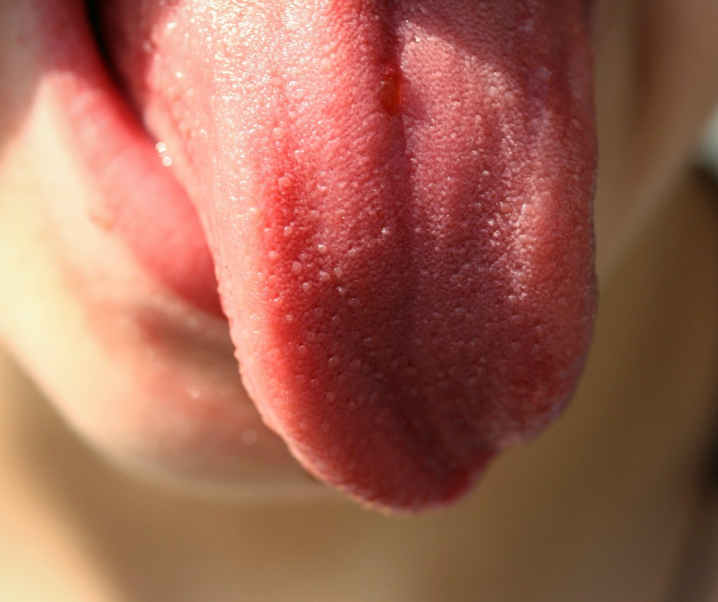 Neue Corona-Symptome entdeckt: Achten Sie auf Haut- und Zungenveränderungen