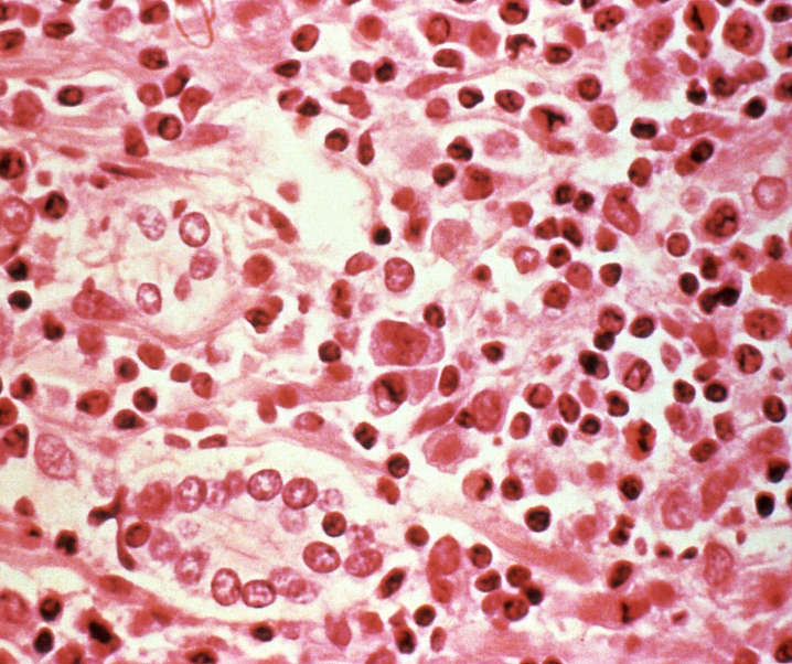 Fettleber-Hepatitis: Killerzellen greifen Leber an