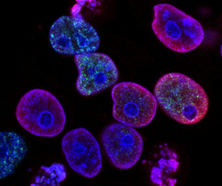 Kampf gegen Krebs: Neue Studien finden Ursache für Tumorwachstum
