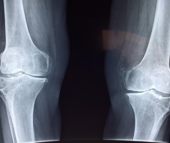 Diagnose: Arthrose oder Arthritis – Knochenveränderungen im Alter