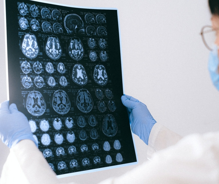 Chronische Kopfschmerzen: Neueste Forschung könnte Migräne-Therapie revolutionieren
