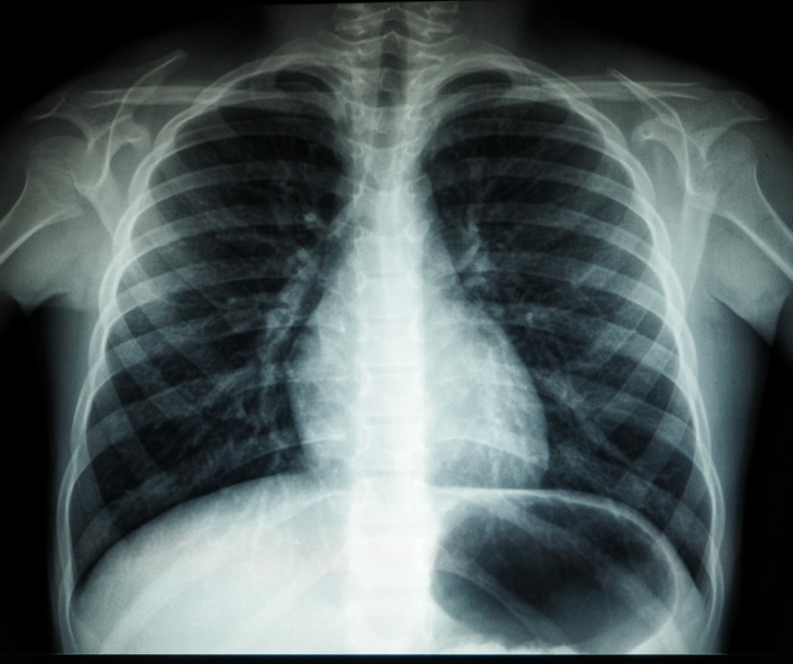 Forschungsdurchbruch: Röntgenbilder sagen Herzprobleme voraus