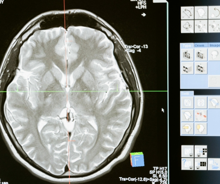 Menschliches Gehirn noch komplexer: Forscher entdecken vierte Hirnhautschicht