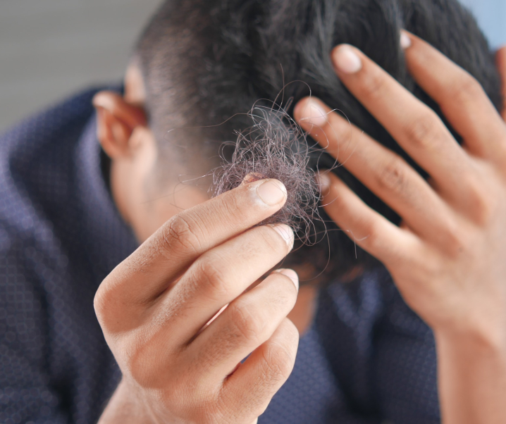 Alopecia Areata: Mysteriöse Krankheit führt zu Haarausfall
