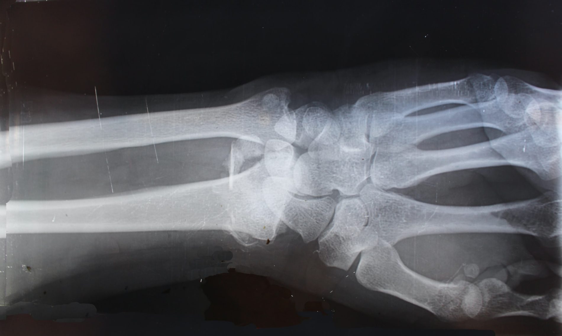 Röntgenaufnahme des Handgelenks